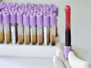 Blood Test for Multiple Cancers: Many False Positives