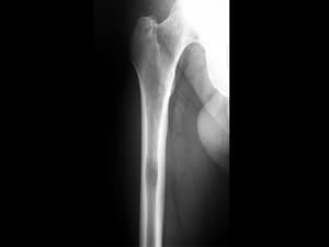 Bone Metastases Treated in a FLASH: One Dose of Proton RT